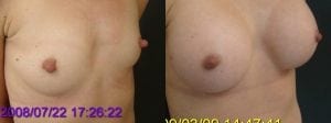 Breast augmentation actual patient results