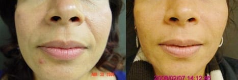 Top-10-Uses-for-Restylane-and-Juvederm-in-Plano,-Frisco,-and-McKinney