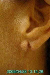 Ear repair before 