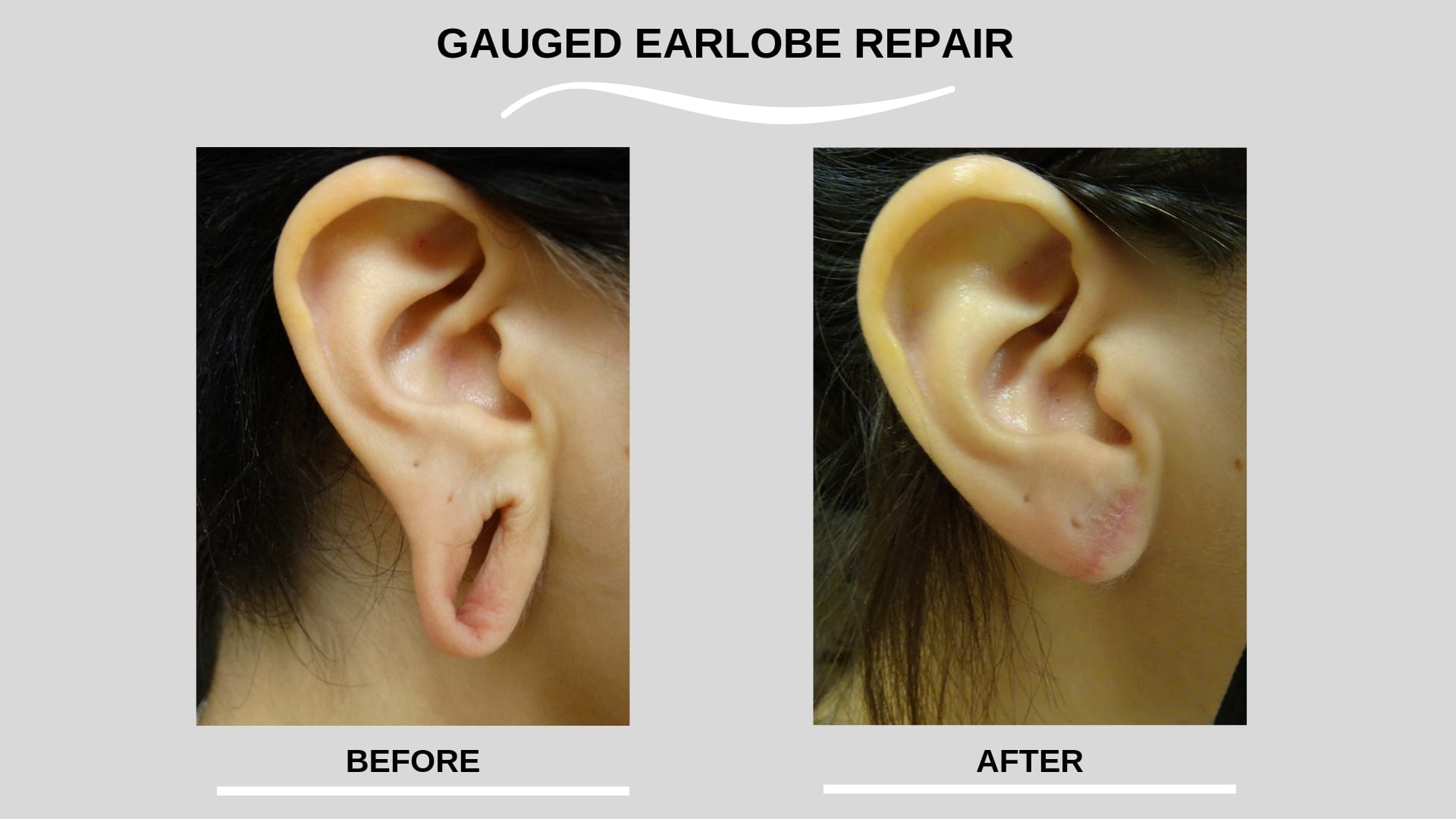 Ear Lobe Surgery Earlobe Repair Or Split Earlobe Surgery Is A Quick