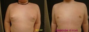 Gynecomastia actual patient results