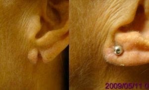 Earlobe repair actual patient