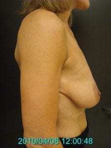 Breast Augmentation Before 4