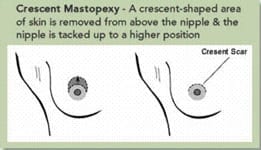 Diagram of crescent mastopexy