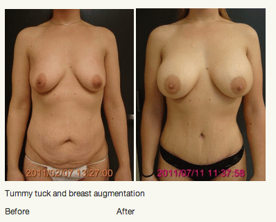 Tummy Tuck and Breast Aug patient results