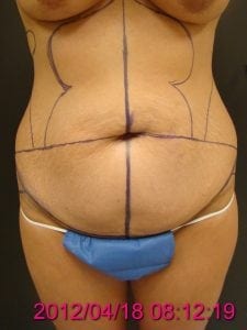 Tummy Tuck Patient Before