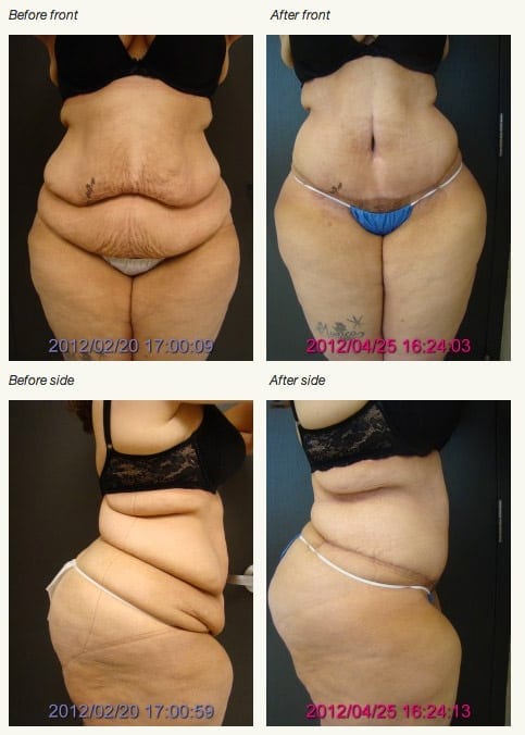 Is a Reverse Tummy Tuck Right for You? - Blogs by Ronald M. Friedman, M.D.