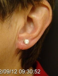 after earlobe reduction wedge