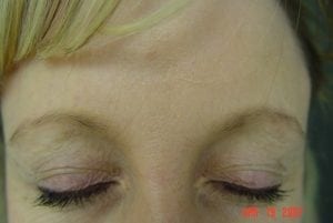 Botox to glabella after