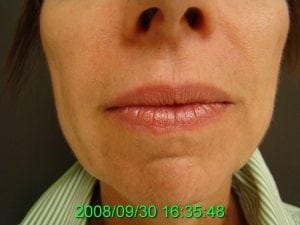 Restylane to the nasiolabial folds after