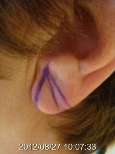 Suture-Free Ear Lobe Repair at Skinaa Clinic, Advanced Stitch-Less Ear  Lobe Repair Surgery