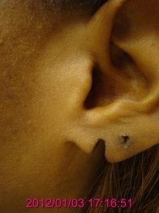 Before torn earlobe repair