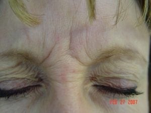 Botox to glabella before