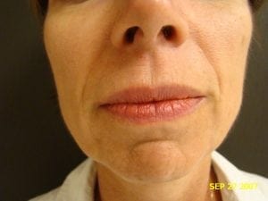 Restylane to the nasiolabial folds before