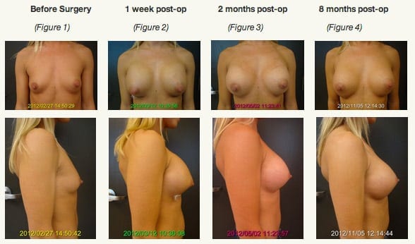 High-And-Tight-Breast-Implants