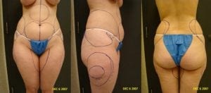 Liposuction of abdomen, hips, flanks, inner and outer thighs results