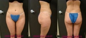 Liposuction of abdomen, hips, flanks, inner and outer thighs results 2