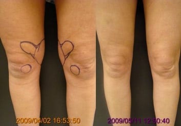 Liposuction of knees results