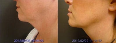 Liposuction of submental (under the chin) results