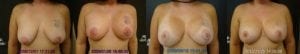 Breast Augmentation with Lift Sequence