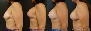 Breast Augmentation with Lift Sequence 2