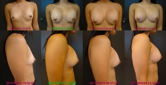 Breast implants and big nipples Are My Breast Implants Too High Blogs By Ronald M Friedman M D