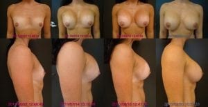 Silicone Gel Breast Implant Sequence