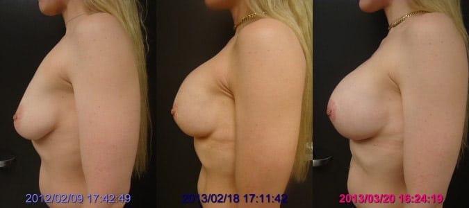 Before / 1 year After Surgery / After Capsule Release 