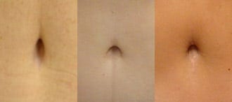 Belly button after tummy tuck performed by Dr. Friedman.
