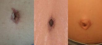 Belly button after tummy tuck performed by other surgeons.