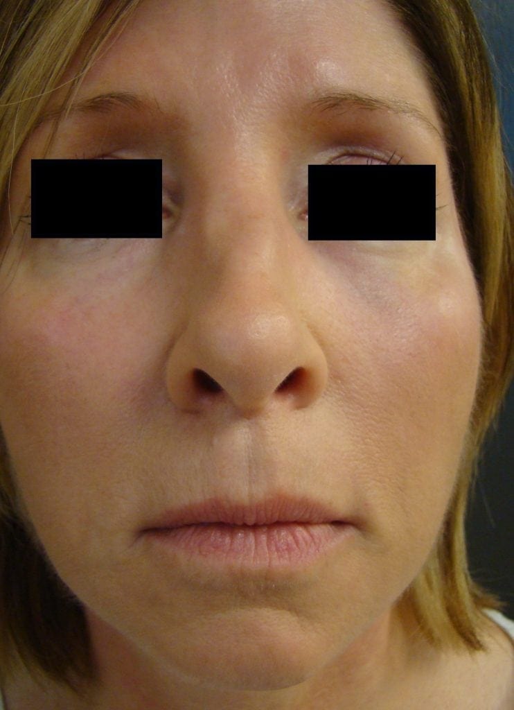 Nonsurgical Rhinoplasty with Injectable Fillers Blogs by