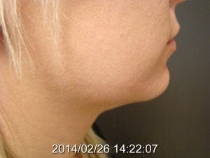 Neck Liposuction After 2