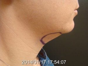 Neck Liposuction Before 2