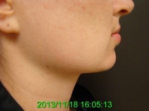 Neck Liposuction After 3
