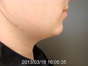 Neck Liposuction Before 3