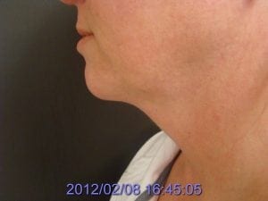 Neck Liposuction Before