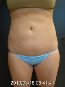 Liposuction results before