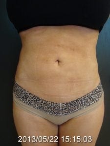 Liposuction results after