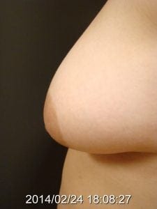 flat nipple side before