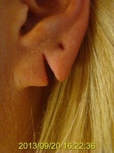 Can I Repair and Repierce My Earlobes at the Same Time? - Blogs by Ronald M. Friedman, M.D.