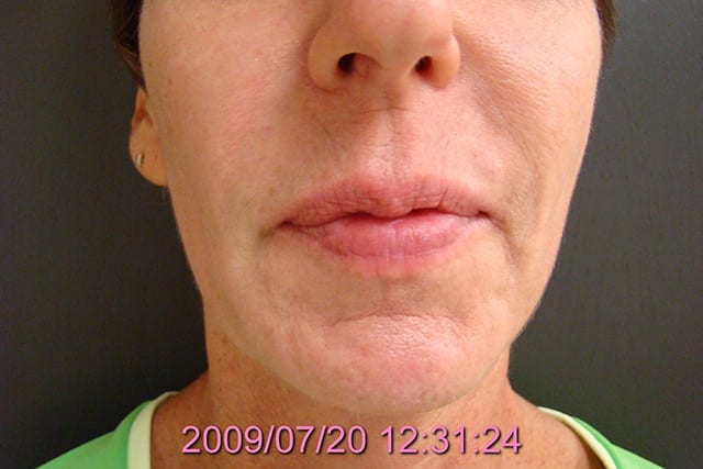 Non-surgical patient after