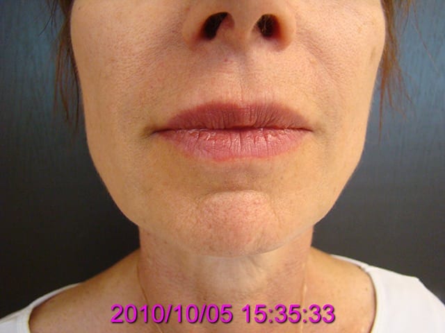 Non-surgical patient after 3 years