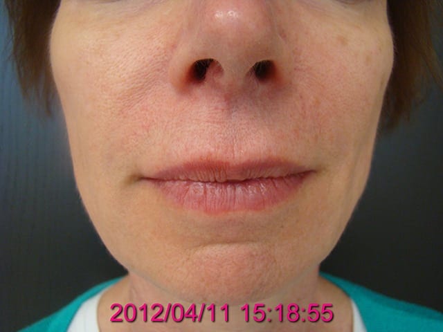 Non-surgical patient after 5 years