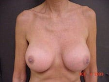 Breast Implant Results After