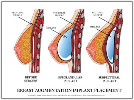 Breast Implant Placement Diagram