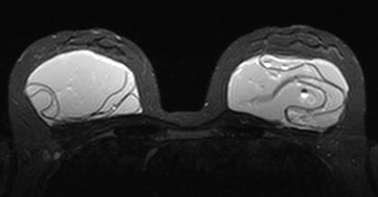 MRI of implants