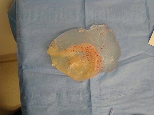 example of ruptured implant 2