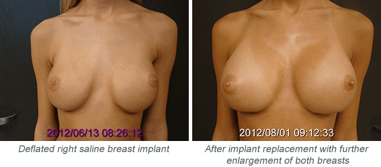 Breast Augmentation Actual Patient Results 2