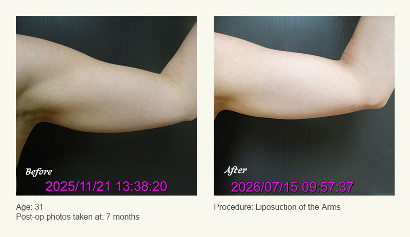Liposuction Surgery in Dallas & Plano - Patient 4