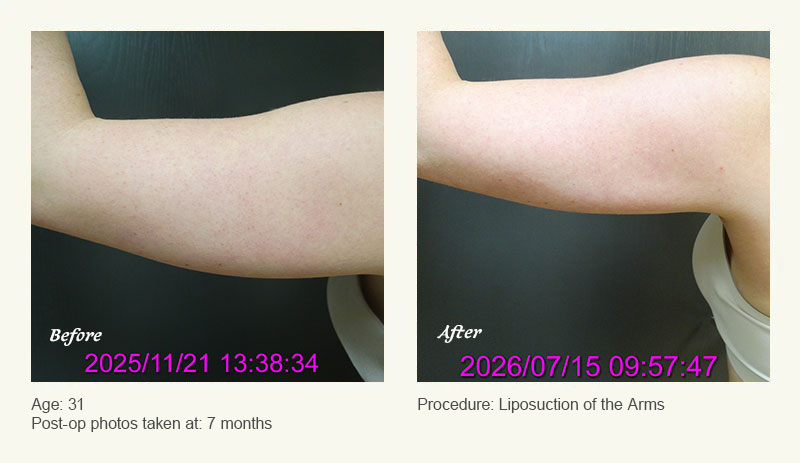 Liposuction Surgery in Dallas & Plano - Patient 3